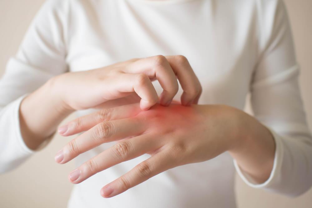 Woman scratching rash on hand