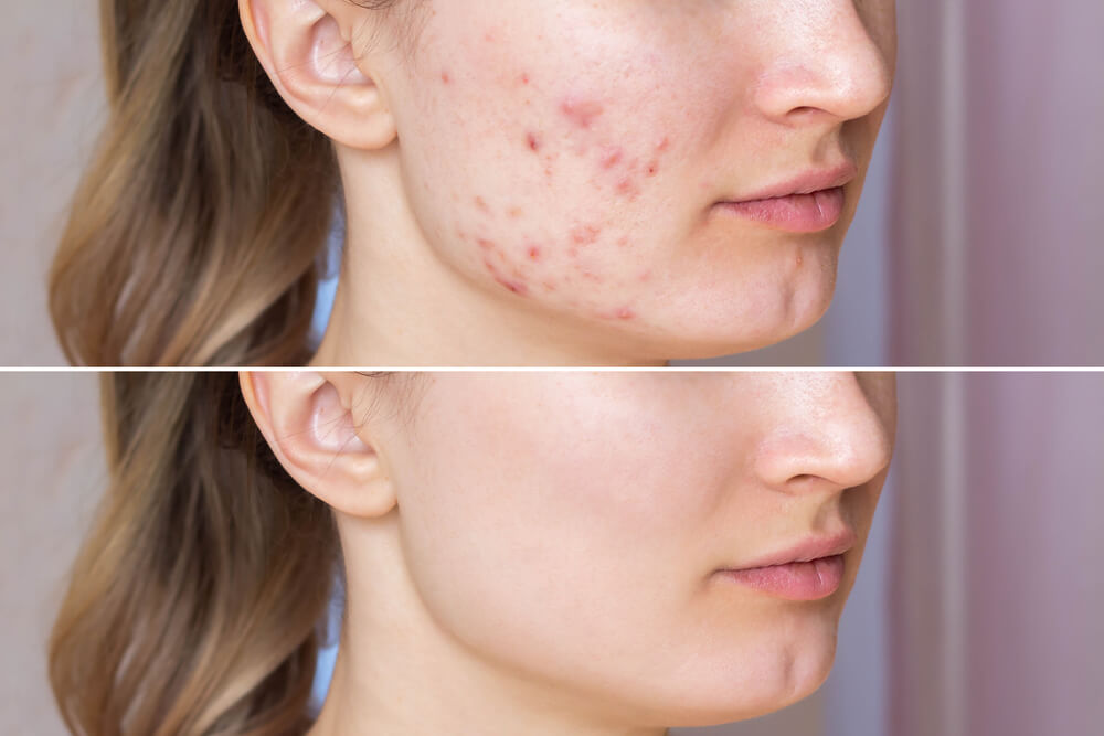 Dealing with Acne: Causes, Treatments, and Prevention
